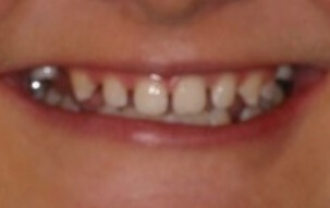 Smile with unevenly sized teeth with large gaps between them