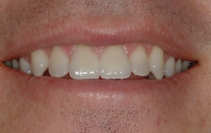 Bright smile after top front teeth are repaired