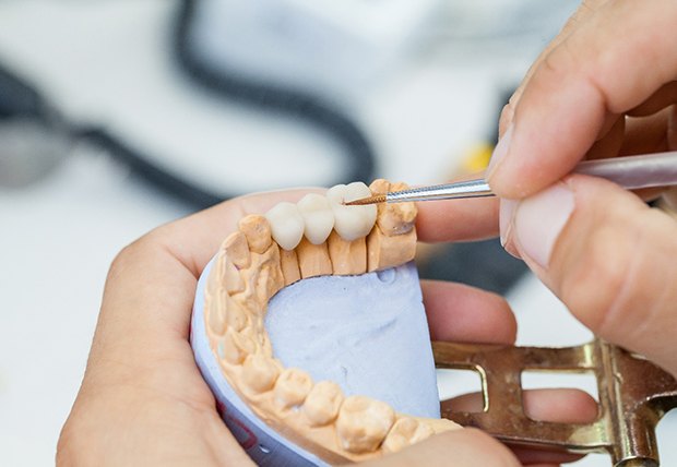 Dental bridge on model teeth