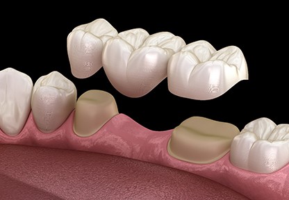 3D model of a traditional dental bridge