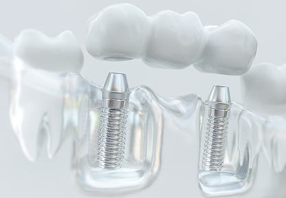 3D model of an implant bridge