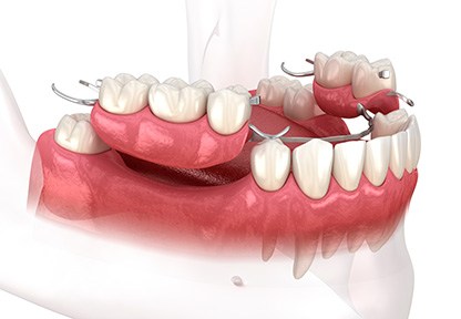 3D image of partial dentures