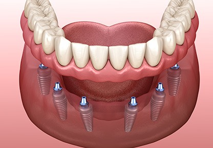 3D render of an implant denture